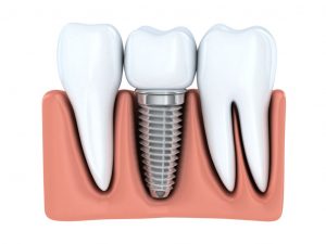 Zastosowanie implantu zębowego w przypadku braku pojedynczego zęba