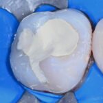 biodentine leczenie zachowawcze prochnica poznan wudel