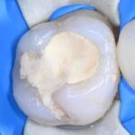 biodentine leczenie zachowawcze prochnica poznan wudel
