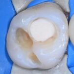 biodentine leczenie zachowawcze prochnica poznan wudel
