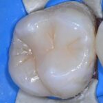 biodentine leczenie zachowawcze prochnica poznan wudel