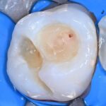 biodentine leczenie zachowawcze prochnica poznan wudel